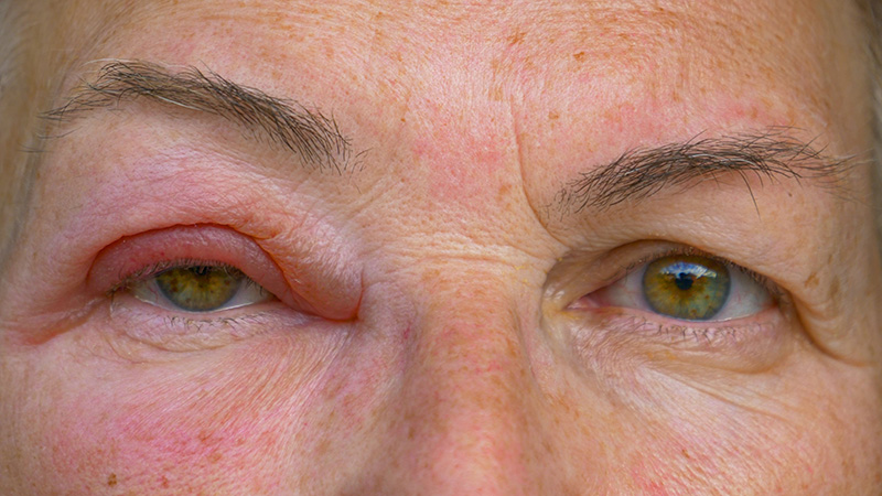 Lady with a swollen eye looks into camera