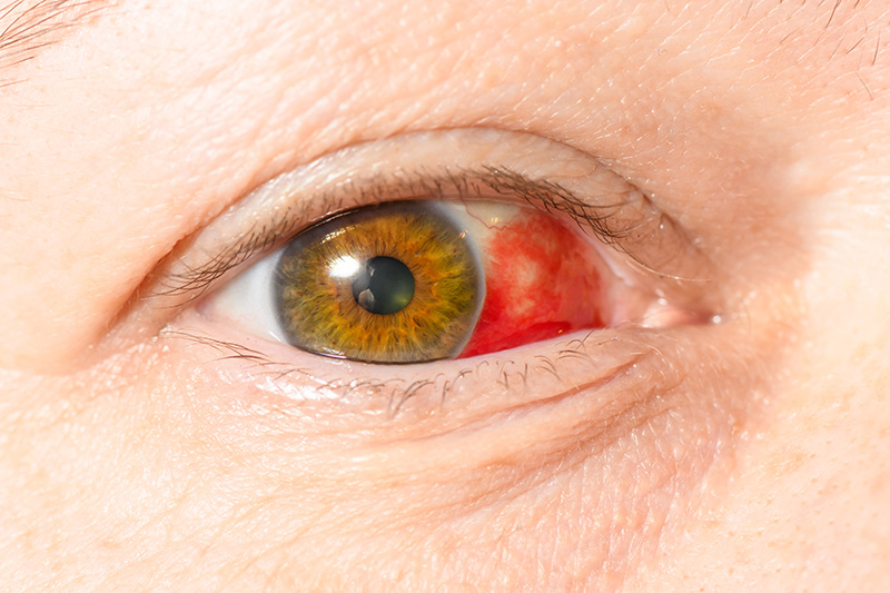 Close up of woman’s face showing red bloodshot eye