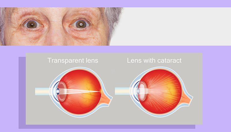 an image example of cataract illness
