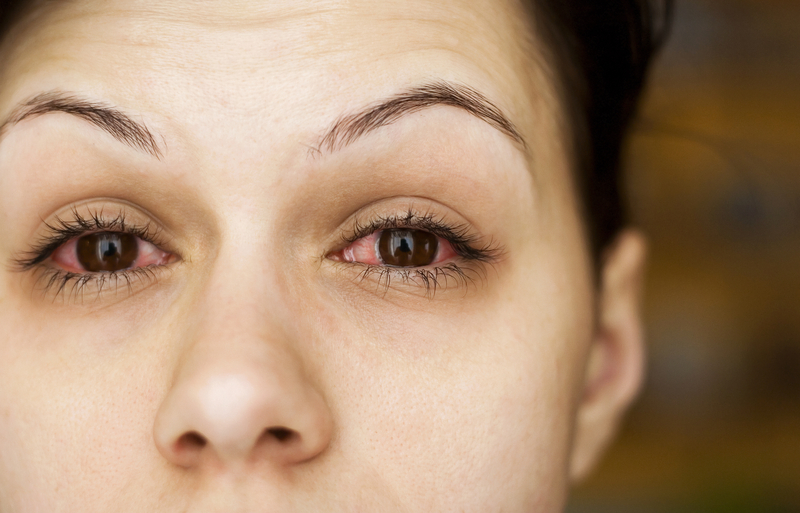 Big close up of womans face with very red irritated eyes